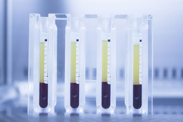 Blood samples separated for PRP Therapy