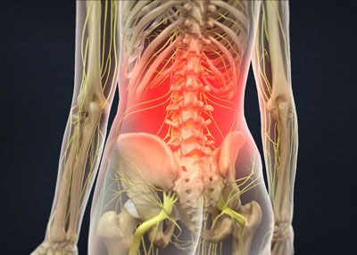 Lumbar Back Pain